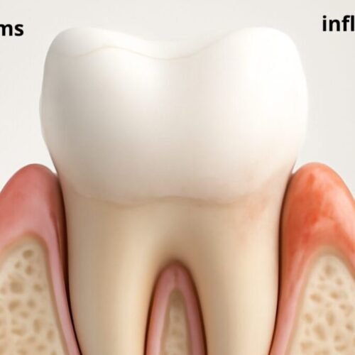 Gum disease treatment options range from professional deep cleaning (scaling and root planing) and antibiotic therapy for early-stage gingivitis to surgical procedures like flap surgery or bone grafts for advanced periodontitis.