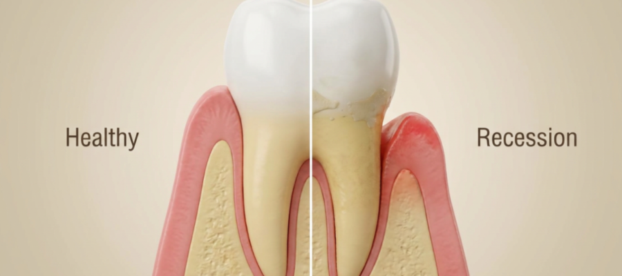 Gum recession happens when the gum tissue surrounding the teeth pulls back, exposing more of the tooth or its root.